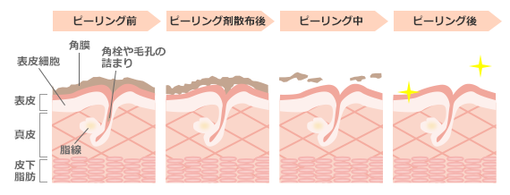 chemical_peeling02.png